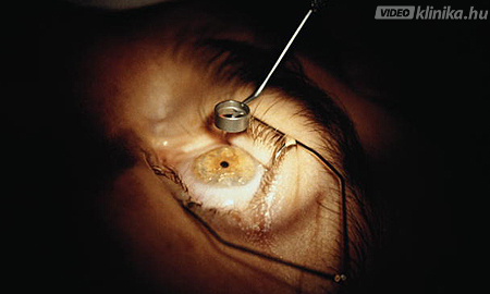 Lézeres szemműtét - a látásjavítás lépései | FocusMed