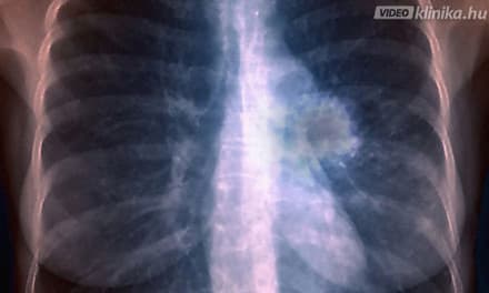 tüdőrák áttét giardia ciszták az emberi székletben