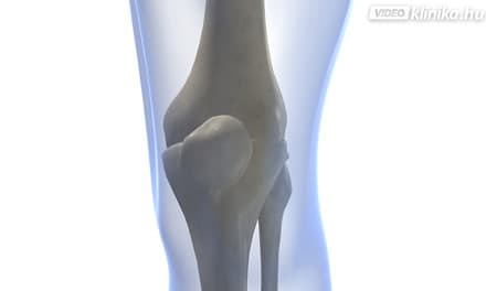 Meniszkusz repedés térdízület kezelése, Hogyan sérülhet a meniscus?