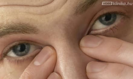 Betegségek, amiket a csipás szem jelez - EgészségKalauz