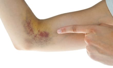 ízületi fájdalom zúzódás után radonfürdők az artrózis kezelésére